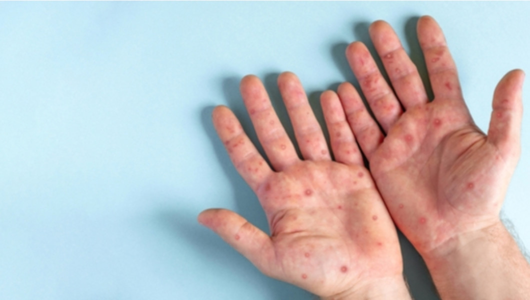 La variole du singe ou mpox :  connaître la maladie | Crédit photo : AlloDocteur